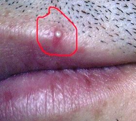 Points Blancs Sur Les Levres 8 Traitements Simples Efficaces