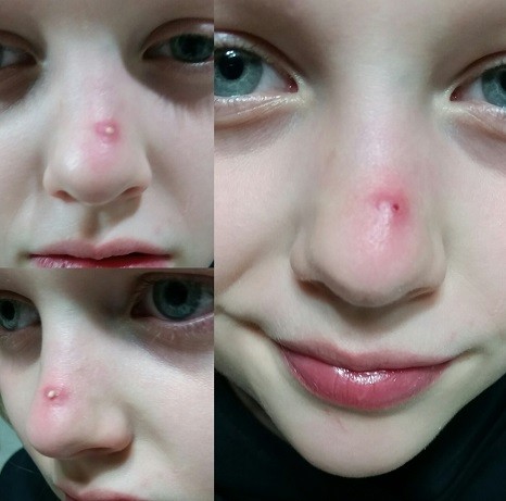 gros boutons du nez